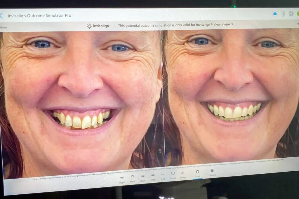 Before and After. Invisalign Cornwall. Based in Wadebridge. Wadebridge Dental Care