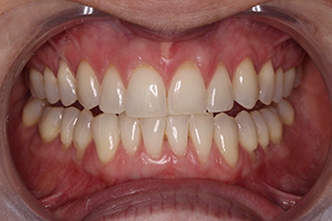 tooth-whitening-after