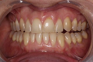 tooth-whitening-before