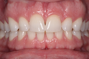 tooth-whitening-after