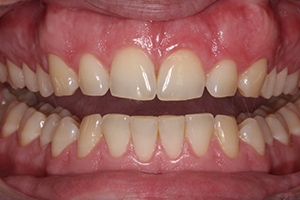 tooth-whitening-before