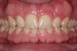 tooth-whitening-before