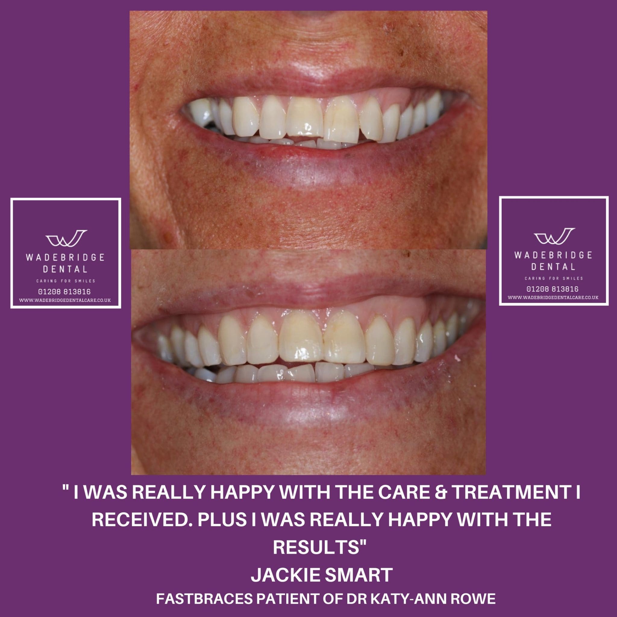 fast braces Wadebridge Dental Care