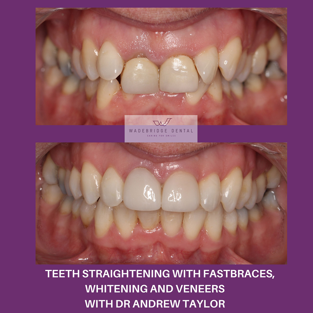 Fast Braces in Cornwall, How to get straight teeth