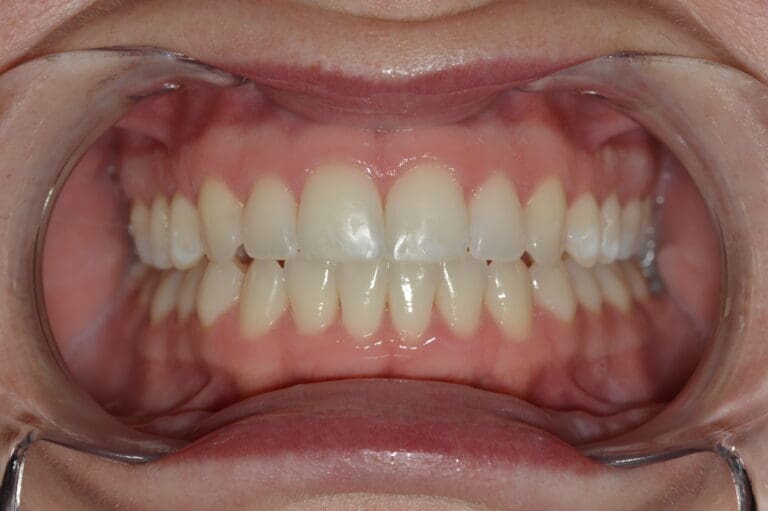Invisalign at Wadebridge Dental, Cornwall