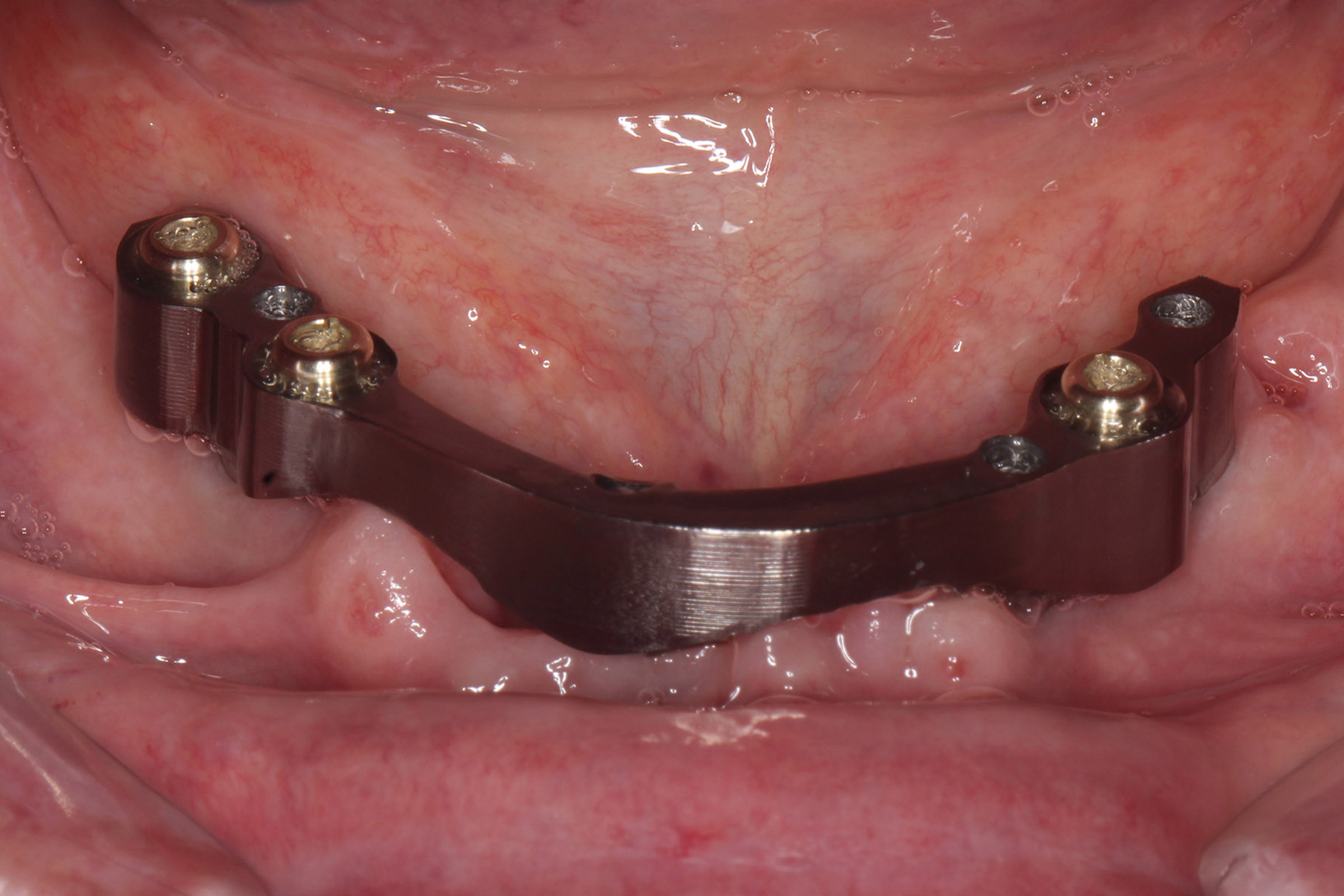Implant-retained bridge treatment at Wadebridge Dental Care, Cornwall (1 of 6)